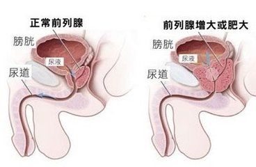 前列腺增生药物,前列腺增生原因,前列腺增生症状,前列腺增生治疗