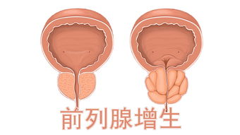 前列腺增生症状,前列腺增生表现,前列腺增生病因,前列腺增生预防,前列腺增生检查,前列腺增生危害